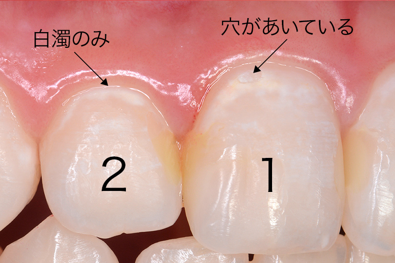 う蝕写真1