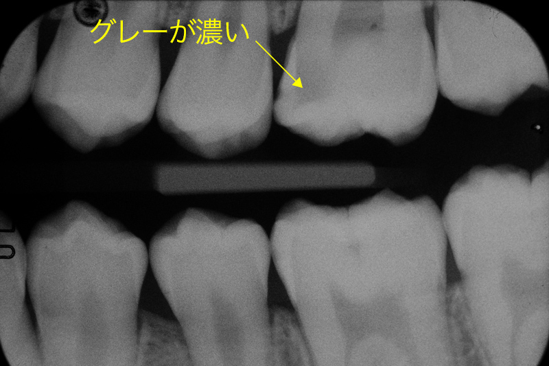 う蝕写真2