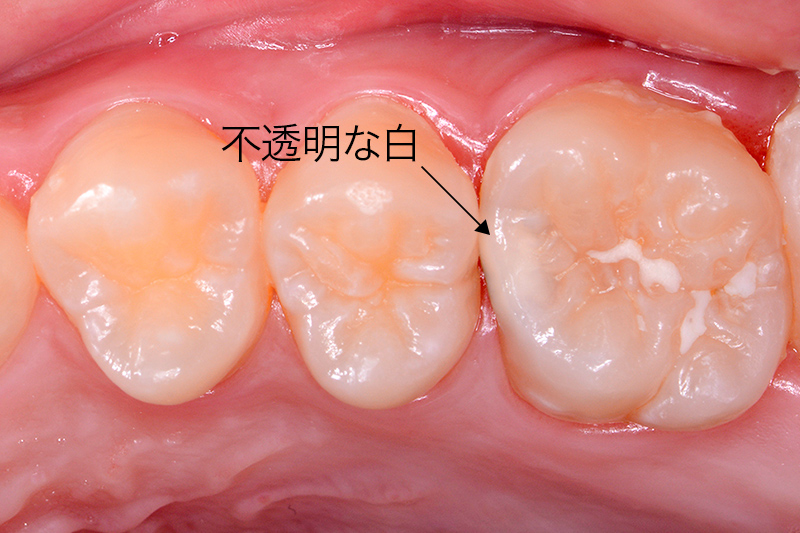 う蝕写真3