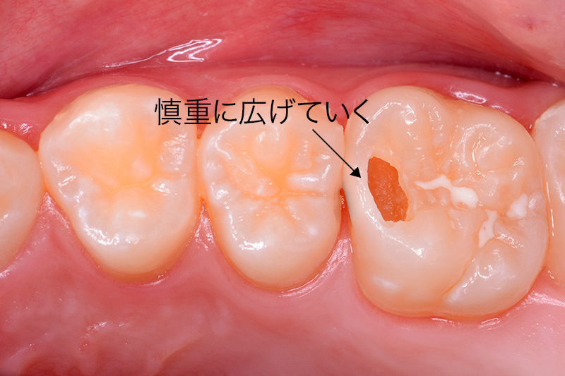 う蝕写真4